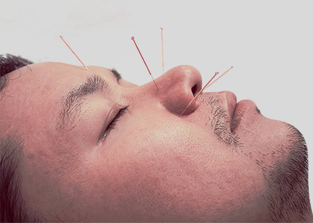 Best Acupuncture Treatment in Hyderabad