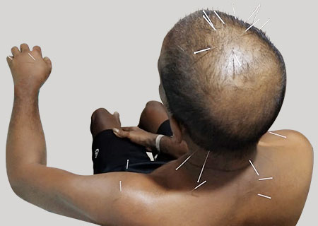 Doctors for Acupuncture Treatment in Hyderabad